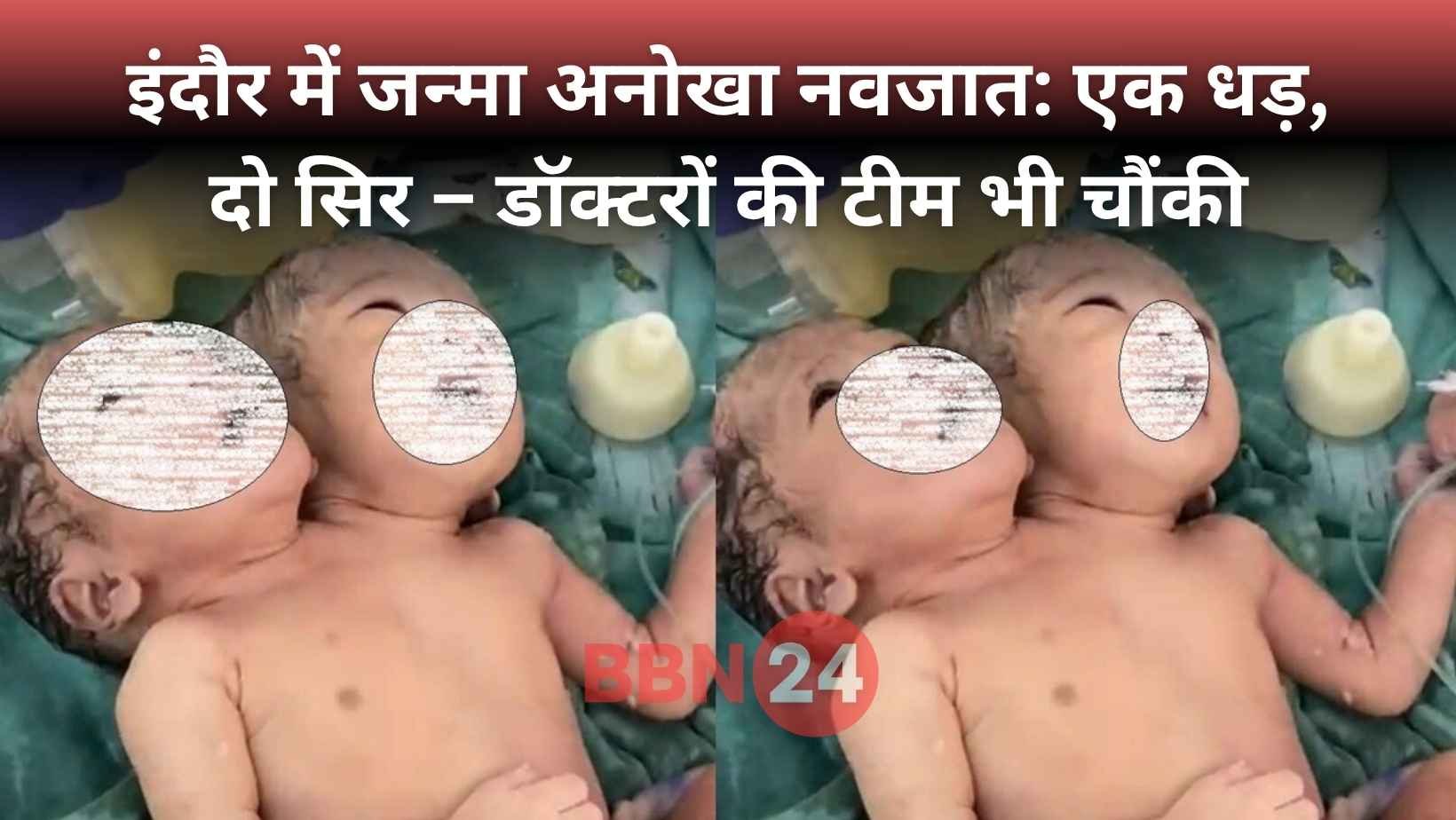 Two Headed Baby Born In Indore